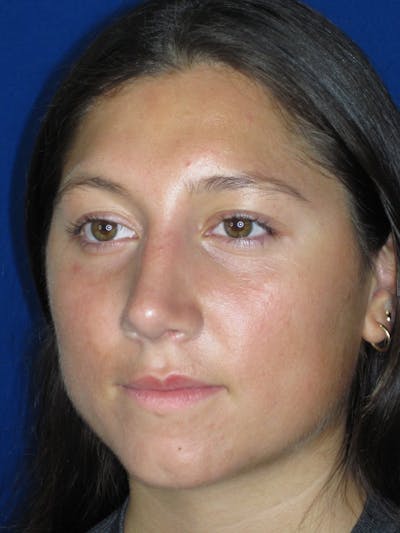 Rhinoplasty Before & After Gallery - Patient 139842 - Image 8
