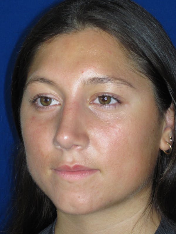 Rhinoplasty Before & After Gallery - Patient 139842 - Image 8