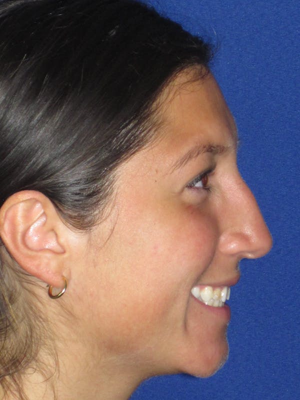 Rhinoplasty Before & After Gallery - Patient 139842 - Image 5