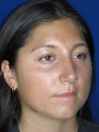 Rhinoplasty Before & After Gallery - Patient 139842 - Image 2