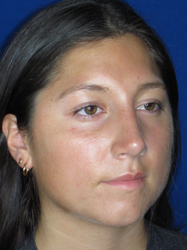 Rhinoplasty Before & After Gallery - Patient 139842 - Image 2