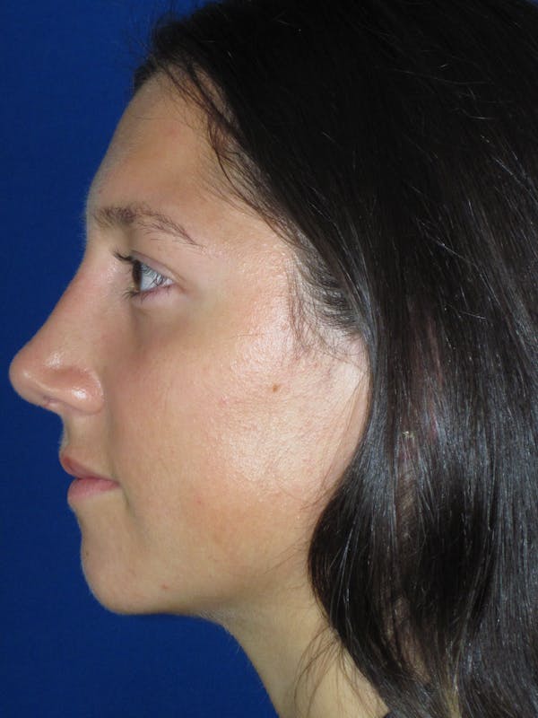 Rhinoplasty Before & After Gallery - Patient 139842 - Image 10