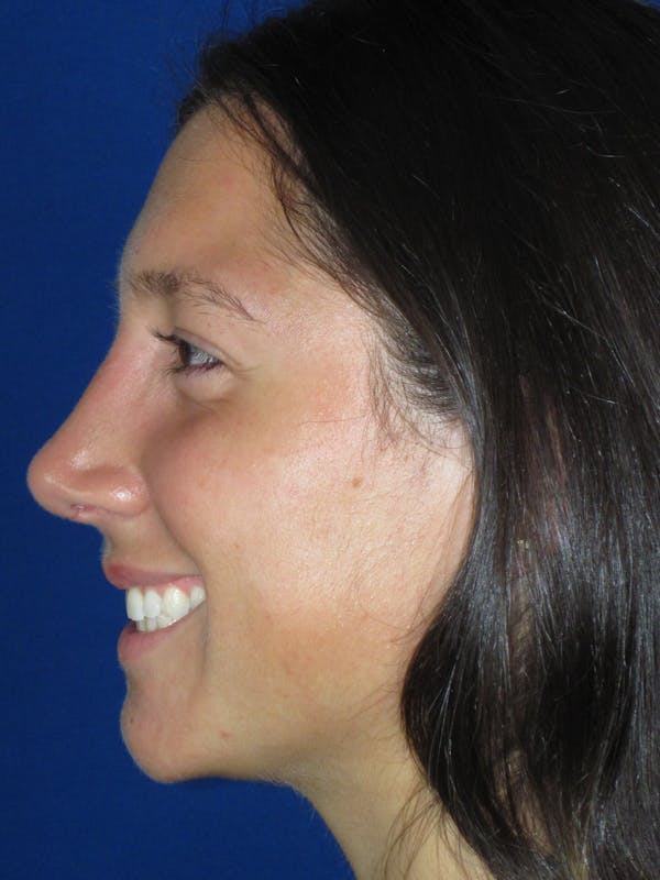Rhinoplasty Before & After Gallery - Patient 139842 - Image 12