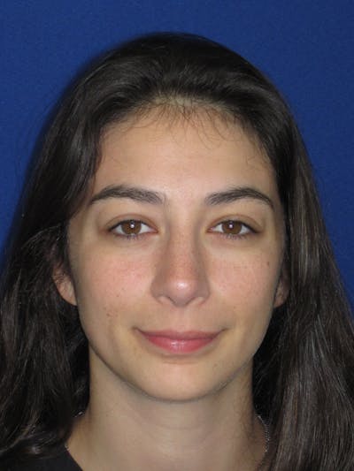 Rhinoplasty Before & After Gallery - Patient 383694 - Image 4