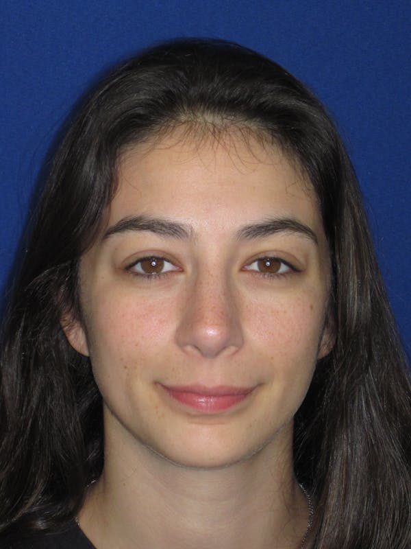 Rhinoplasty Before & After Gallery - Patient 383694 - Image 4