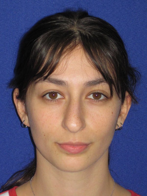 Rhinoplasty Before & After Gallery - Patient 383694 - Image 3