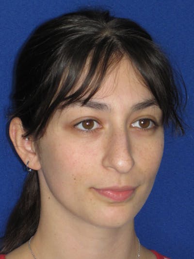 Rhinoplasty Before & After Gallery - Patient 383694 - Image 1