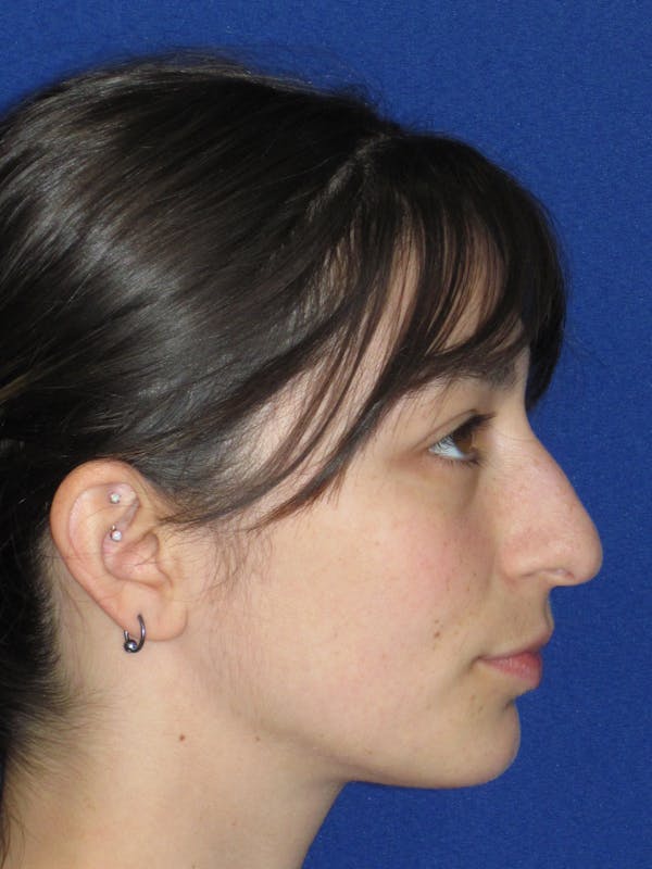 Rhinoplasty Before & After Gallery - Patient 383694 - Image 5