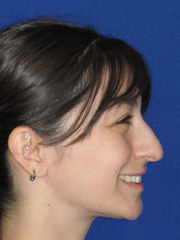 Rhinoplasty Before & After Gallery - Patient 383694 - Image 7
