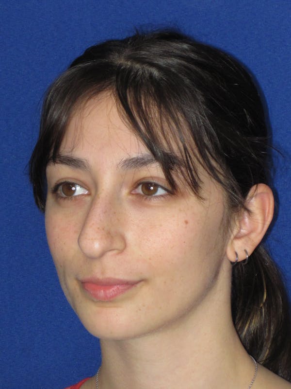 Rhinoplasty Before & After Gallery - Patient 383694 - Image 9
