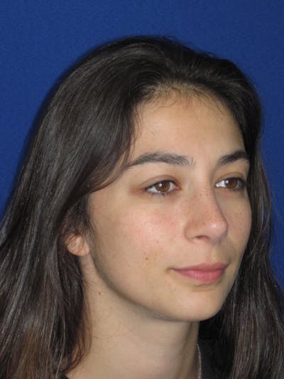Rhinoplasty Before & After Gallery - Patient 383694 - Image 2