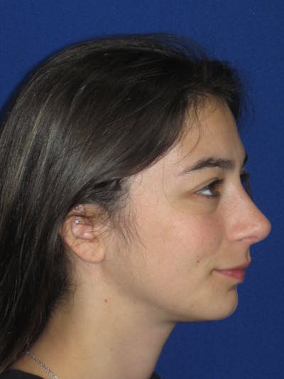 Rhinoplasty Before & After Gallery - Patient 383694 - Image 6