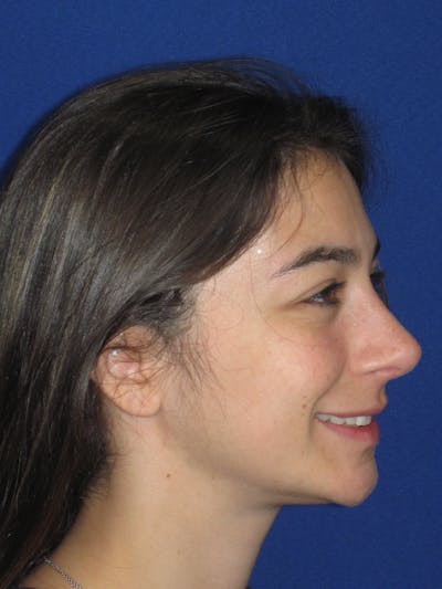 Rhinoplasty Before & After Gallery - Patient 383694 - Image 8