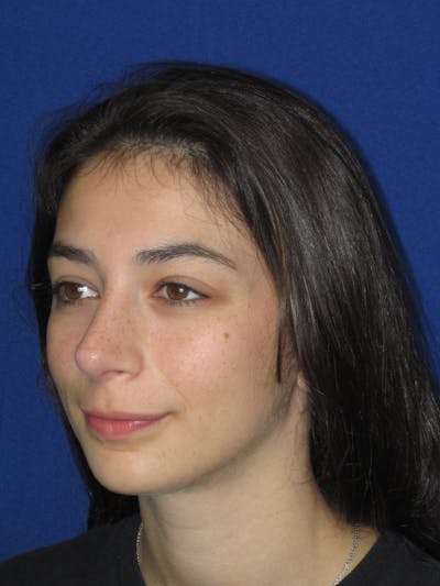 Rhinoplasty Before & After Gallery - Patient 383694 - Image 10