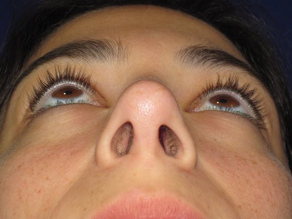 Rhinoplasty Before & After Gallery - Patient 383694 - Image 12