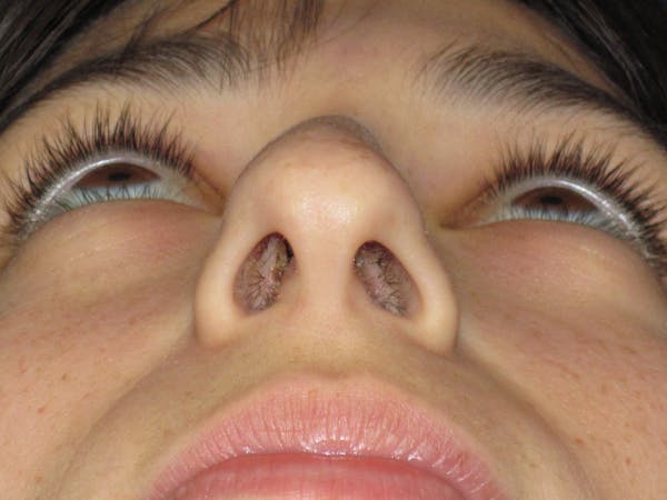 Rhinoplasty Before & After Gallery - Patient 383694 - Image 11