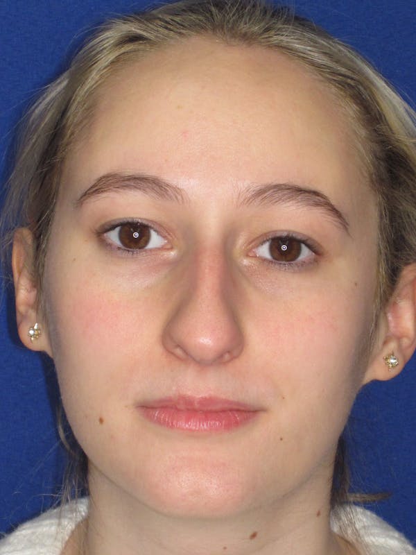 Rhinoplasty Before & After Gallery - Patient 920423 - Image 7