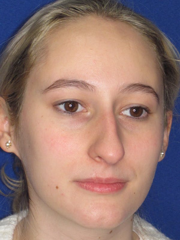 Rhinoplasty Before & After Gallery - Patient 920423 - Image 5