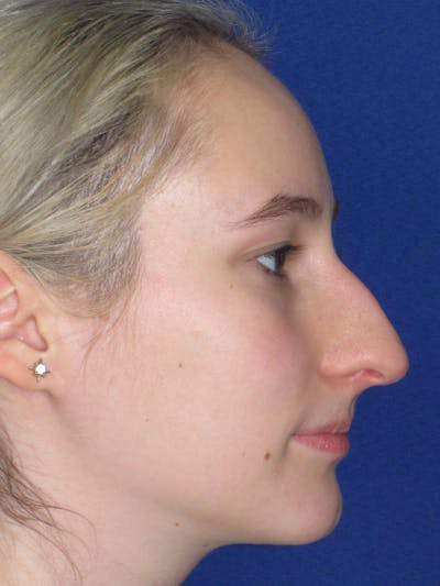 Rhinoplasty Before & After Gallery - Patient 920423 - Image 1
