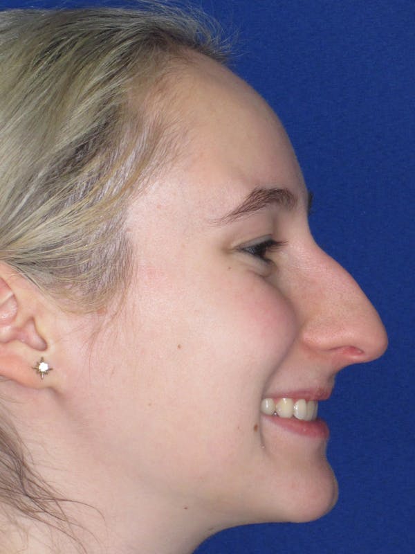 Rhinoplasty Before & After Gallery - Patient 920423 - Image 3