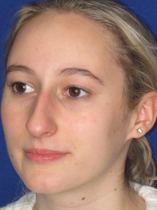 Rhinoplasty Before & After Gallery - Patient 920423 - Image 9