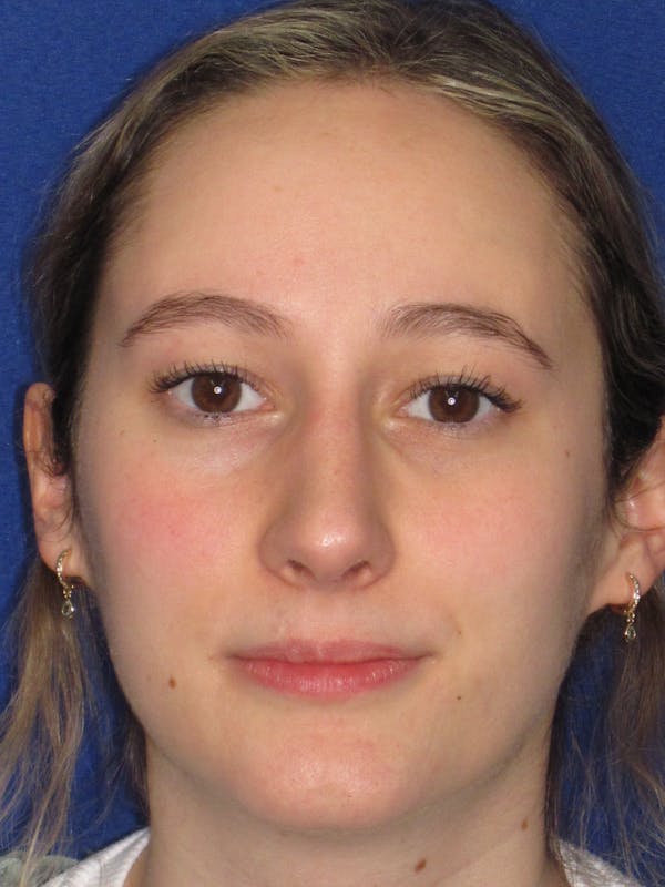 Rhinoplasty Before & After Gallery - Patient 920423 - Image 8
