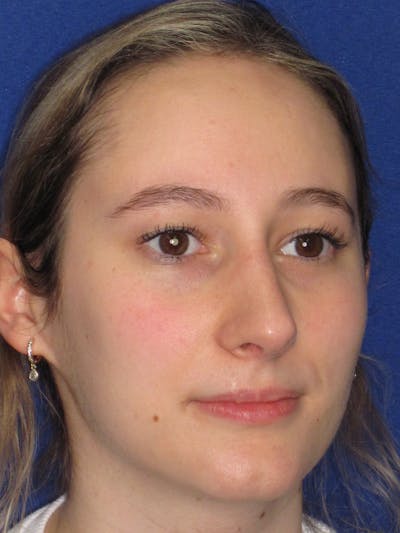 Rhinoplasty Before & After Gallery - Patient 920423 - Image 6