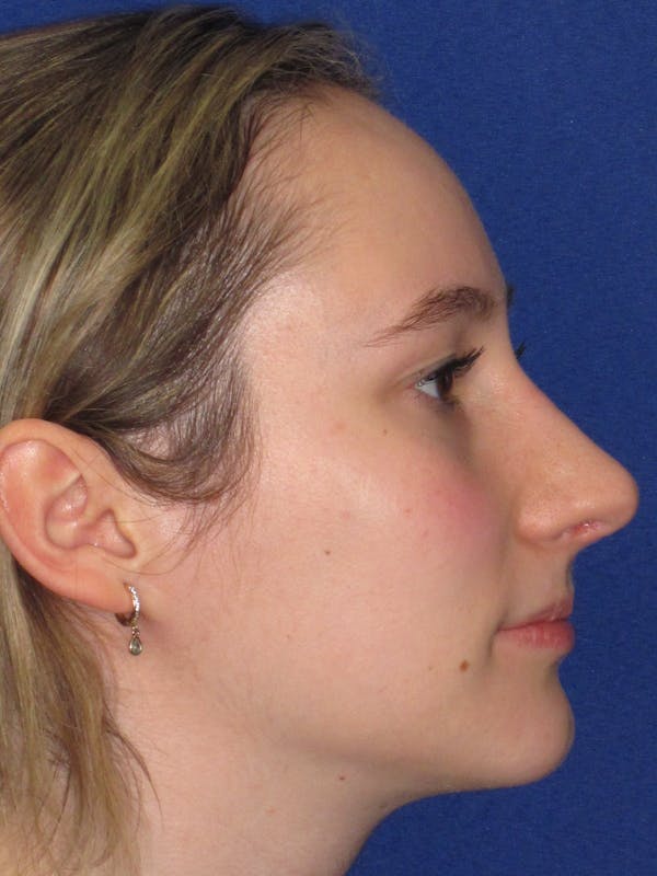 Rhinoplasty Before & After Gallery - Patient 920423 - Image 2