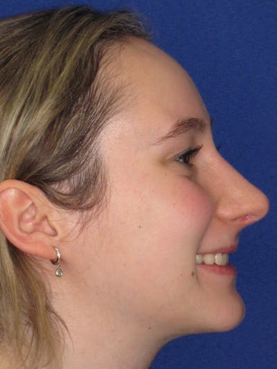 Rhinoplasty Before & After Gallery - Patient 920423 - Image 4