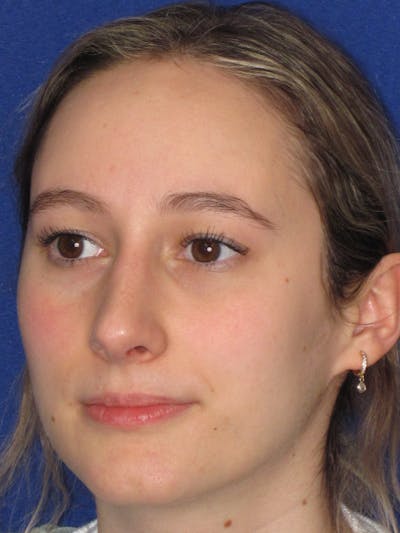Rhinoplasty Before & After Gallery - Patient 920423 - Image 10