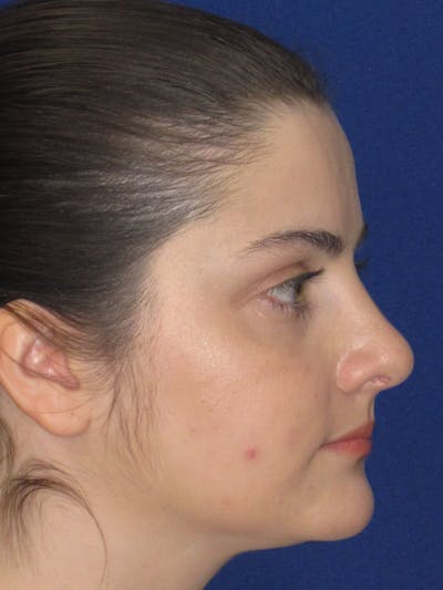 Rhinoplasty Before & After Gallery - Patient 343612 - Image 6