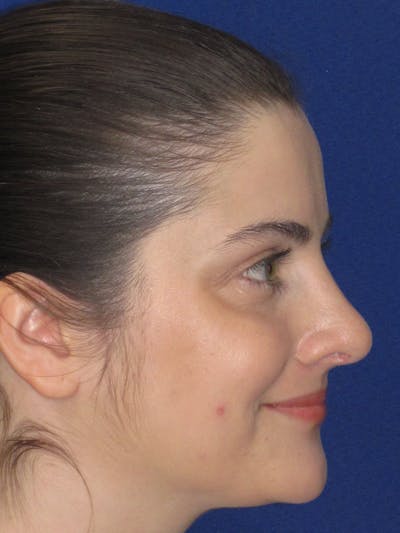 Rhinoplasty Before & After Gallery - Patient 343612 - Image 8