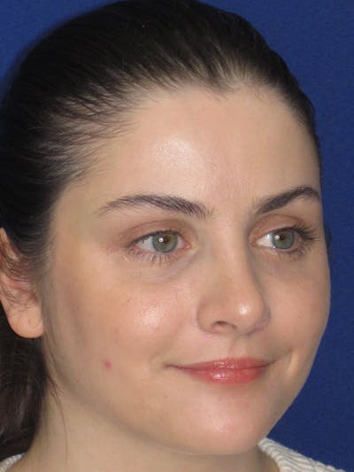 Rhinoplasty Before & After Gallery - Patient 343612 - Image 4