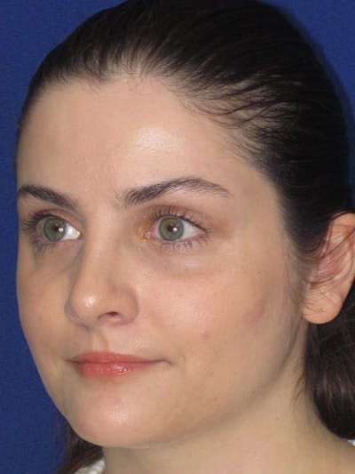 Rhinoplasty Before & After Gallery - Patient 343612 - Image 10