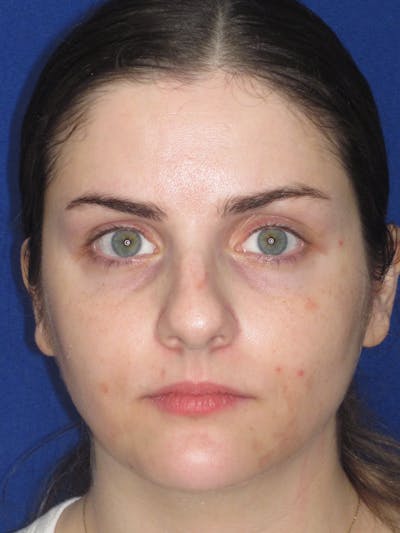 Rhinoplasty Before & After Gallery - Patient 343612 - Image 1