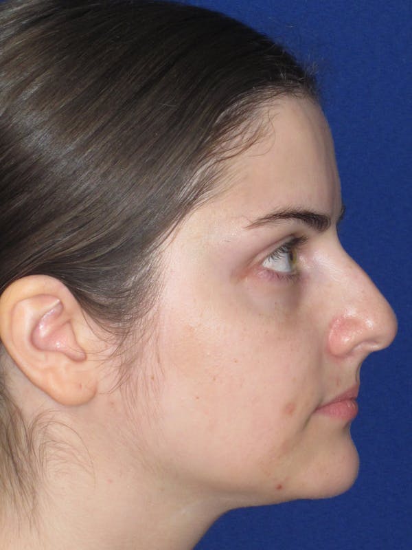 Rhinoplasty Before & After Gallery - Patient 343612 - Image 5