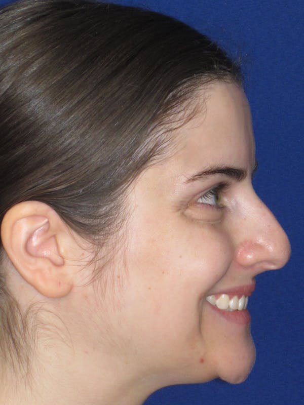 Rhinoplasty Before & After Gallery - Patient 343612 - Image 7