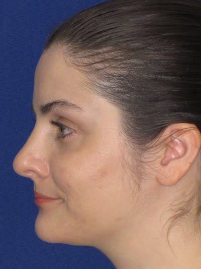 Rhinoplasty Before & After Gallery - Patient 343612 - Image 12