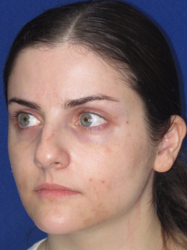 Rhinoplasty Before & After Gallery - Patient 343612 - Image 9