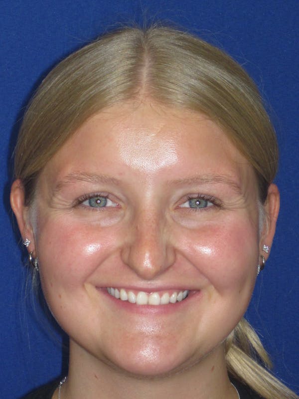Rhinoplasty Before & After Gallery - Patient 199623 - Image 3