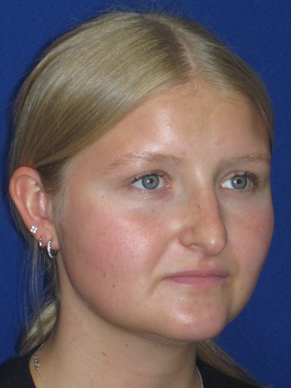 Rhinoplasty Before & After Gallery - Patient 199623 - Image 5