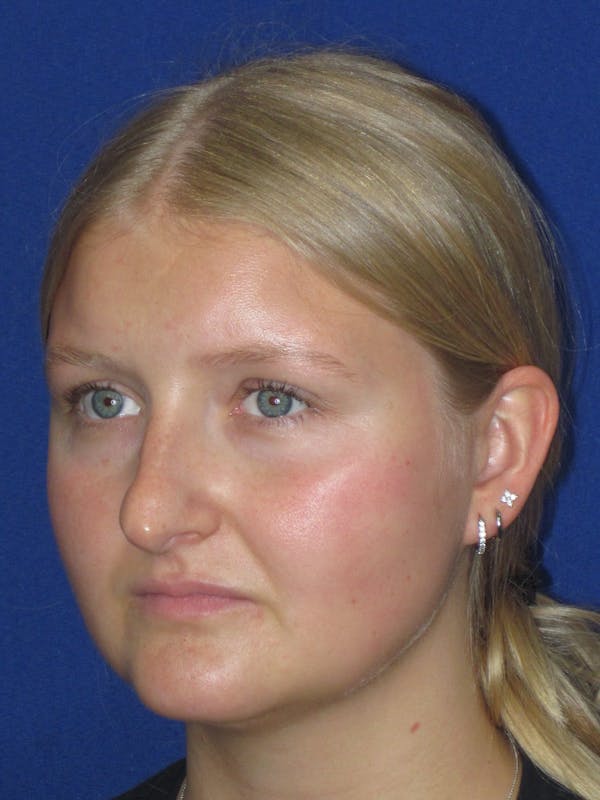 Rhinoplasty Before & After Gallery - Patient 199623 - Image 7