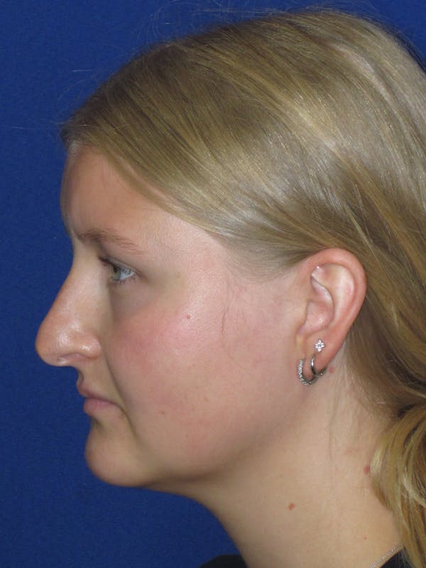 Rhinoplasty Before & After Gallery - Patient 199623 - Image 9
