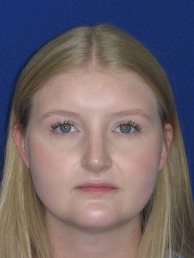 Rhinoplasty Before & After Gallery - Patient 199623 - Image 2