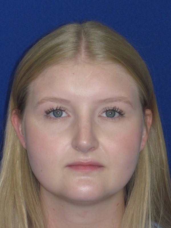 Rhinoplasty Before & After Gallery - Patient 199623 - Image 2