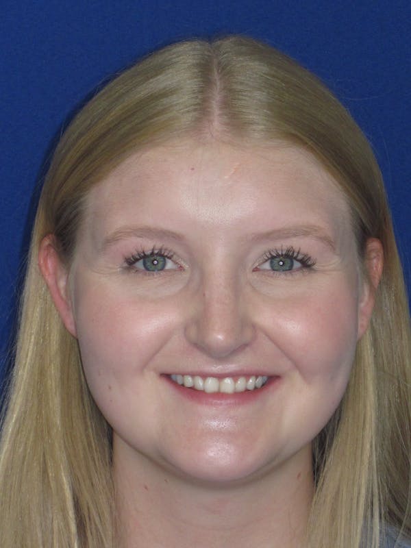 Rhinoplasty Before & After Gallery - Patient 199623 - Image 4