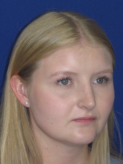 Rhinoplasty Before & After Gallery - Patient 199623 - Image 6