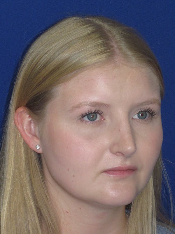 Rhinoplasty Before & After Gallery - Patient 199623 - Image 6
