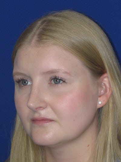 Rhinoplasty Before & After Gallery - Patient 199623 - Image 8