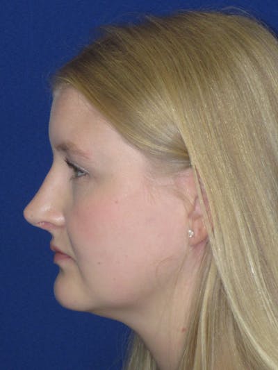 Rhinoplasty Before & After Gallery - Patient 199623 - Image 10